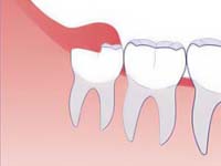 Viêm lợi trùm do răng khôn gây nên