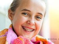 Trẻ em có nên đi niềng răng?