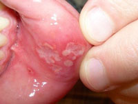 Cẩn thận viêm loét miệng, có thế là biểu hiện của những bệnh nguy hiểm.