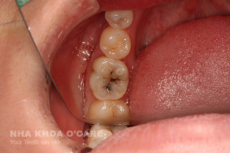 bệnh sâu răng và tác hại