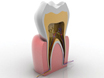 Tìm hiểu về viêm tủy răng