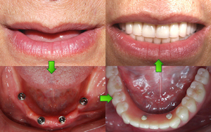 trồng răng giả vĩnh viễn implant
