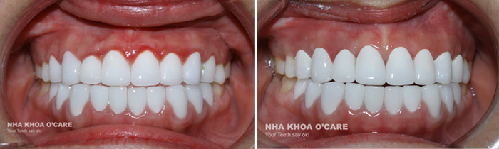 Trước và sau khi điều trị viêm lợi sưng đỏ do bọc răng sứ