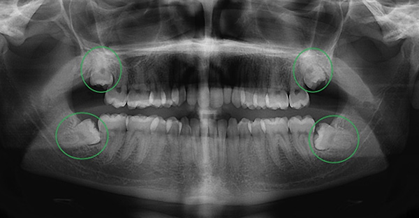 Tìm hiểu về răng số 8 (răng khôn)