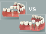 So sánh phương pháp cầu răng sứ và cấy ghép implant