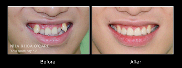 trước và sau niềng răng khểnh