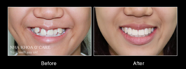 trước và sau niềng răng khểnh
