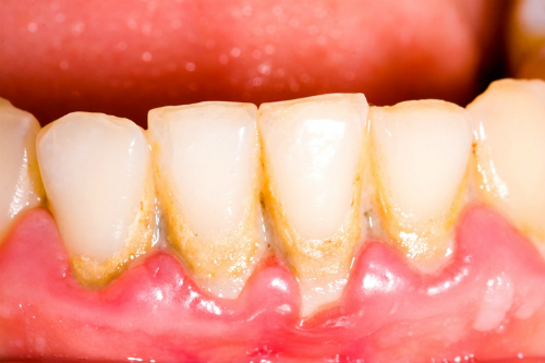 Tìm hiểu về vôi răng, nguyên nhân hàng đầu gây ra các bệnh răng miệng