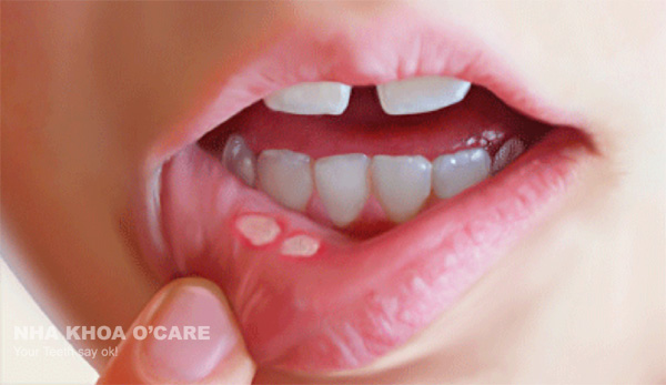 4 bệnh răng miệng phổ biển ở trẻ em