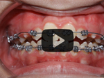 Niềng răng cho trẻ em hiệu quả như thế nào tại Nha Khoa OCARE