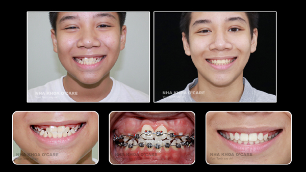 hình ảnh trước và sau niềng răng trẻ em (1)