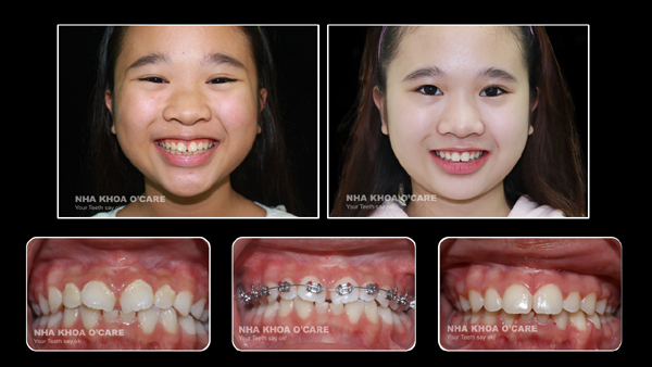 hình ảnh trước và sau niềng răng trẻ em (1)