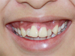Răng mọc sai lệch gây ra những vấn đề gì?