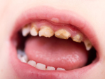 Tình trạng mòn răng sữa ở trẻ nhỏ