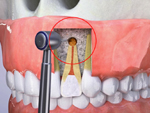 Tìm hiểu về phẫu thuật cắt chóp răng