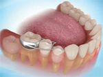 Hàm giữ khoảng giúp răng trẻ mọc thẳng khi răng sữa mất sớm.