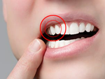 Tại sao bị đau sau khi bọc răng sứ?