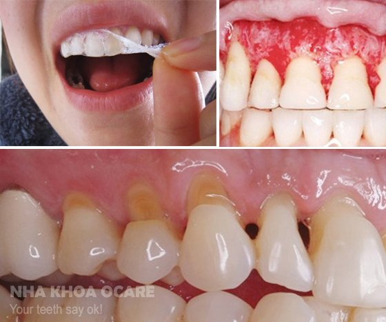 tác hại của miếng dán trắng răng