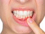 Ngứa lợi răng, nguyên nhân và cách giải quết