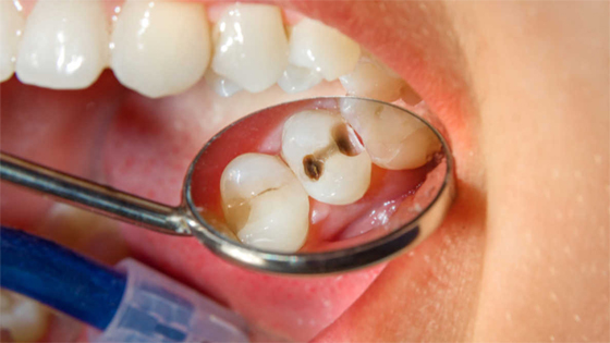 sâu răng gây mất răng vĩnh viễn