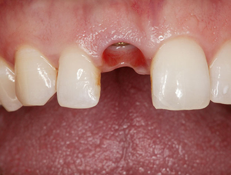 Mất răng thì nên trồng răng sứ như thế nào? Chi phí trồng răng sứ bao nhiêu