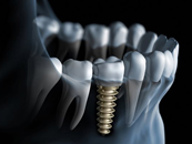 Tư vấn trồng răng implant, giải pháp tái tạo chân răng đã mất