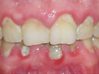 Nướu quanh răng sưng đỏ ngày càng to và chảy máu là bệnh gì?