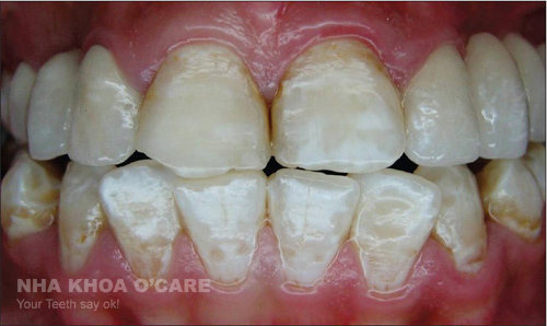 răng nhiễm flour có đốm trắng
