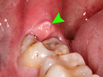 Sưng nướu phía răng trong cùng là bệnh gì?