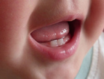 Bé chậm mọc răng có phải do thiếu chất