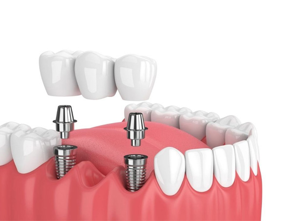 trồng răng implant có đau không?