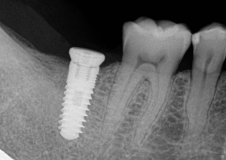 xquang implant