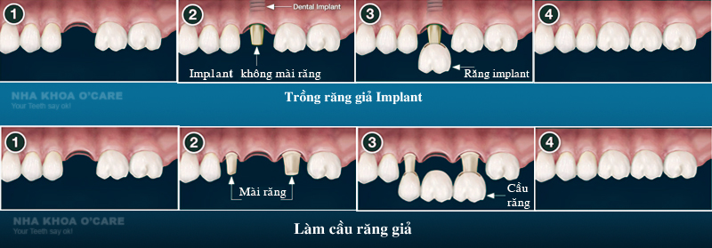 Trồng răng giả implant03