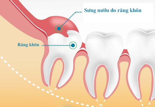 biến chứng viêm lợi chùm do răng khôn gây ra