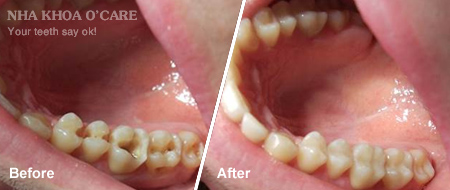 trước và sau trám răng composite 5