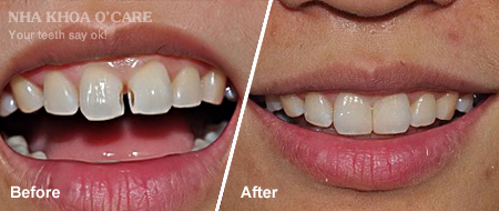 trước và sau trám răng composite 2