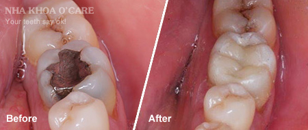 trước và sau trám răng composite 1