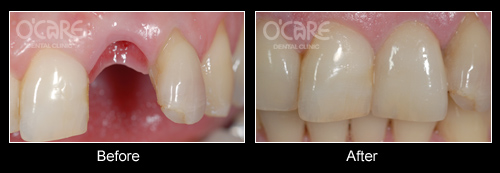 trước và sau khi bọc răng sứ cho răng cửa 