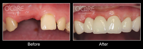 trước và sau khi bọc răng sứ cho răng cửa