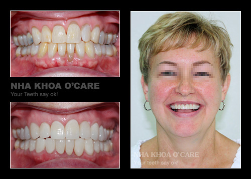 trước và sau khi bọc răng sứ 2