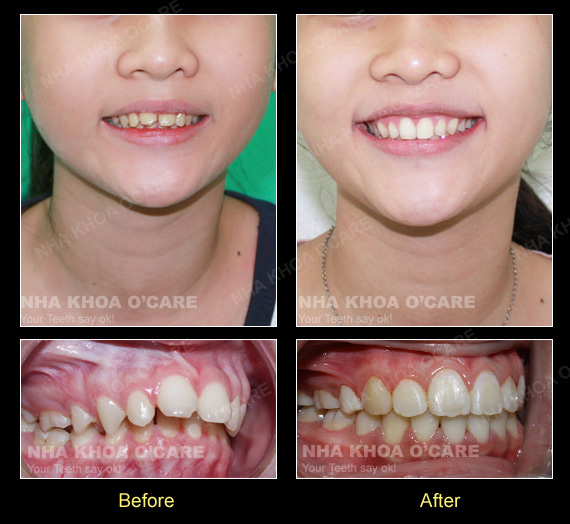 trước và sau khi niềng răng hô