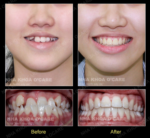 trước và sau niềng răng móm- cắn ngược