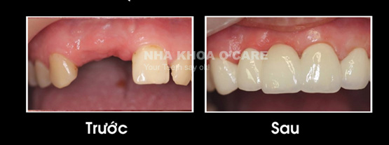 trước và sau bọc răng sứ