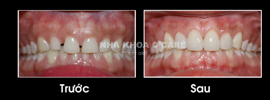 trước và sau bọc răng sứ
