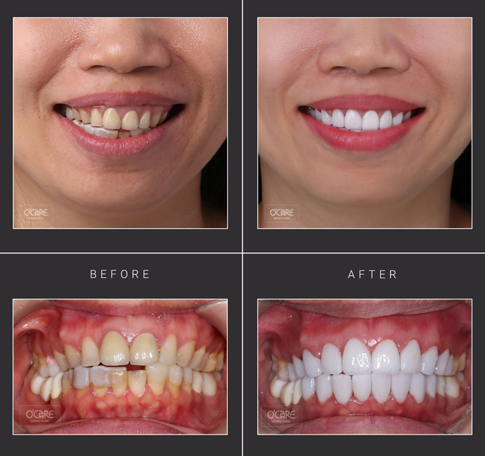trước và sau khi dán răng sứ veneers
