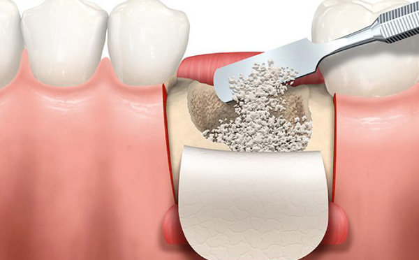 ghép xương trồng răng implant