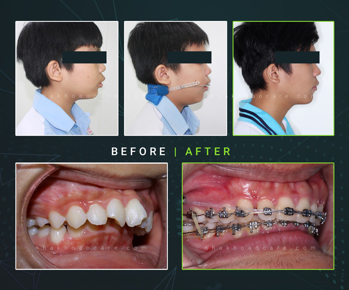 trước và sau khi niềng răng trẻ em