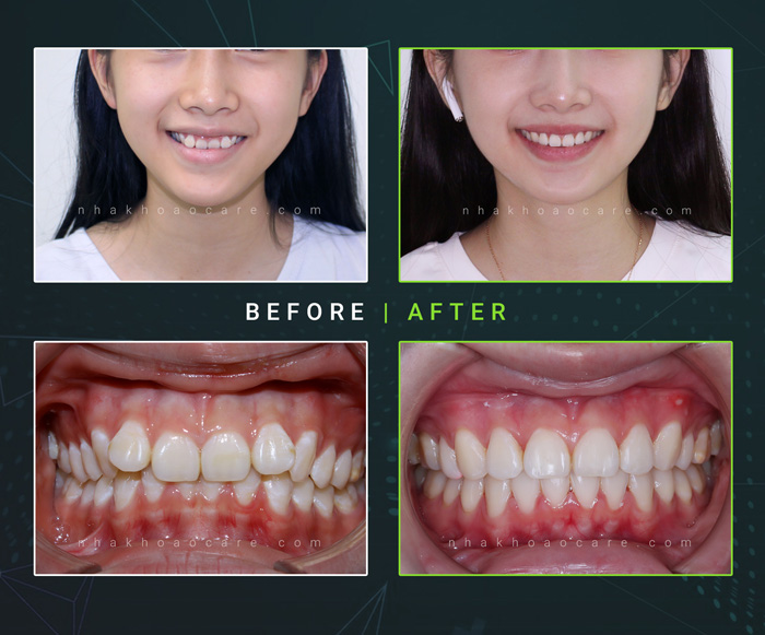 trước và sau khi niềng răng trẻ em