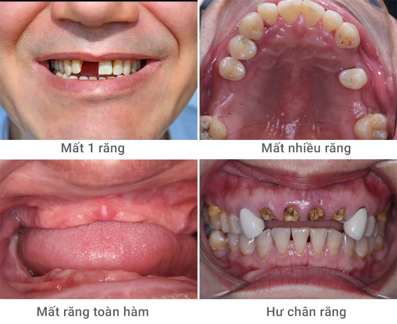 cac truong hop mat rang