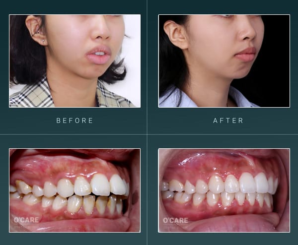Niềng răng hô 1